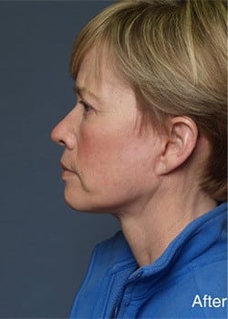 After Image: Fusion Facelift Case 1 - other