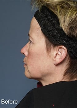 Before Image: Fusion Facelift Case 1 - other