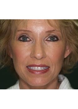 After Image: Ageless Mini Lift - front