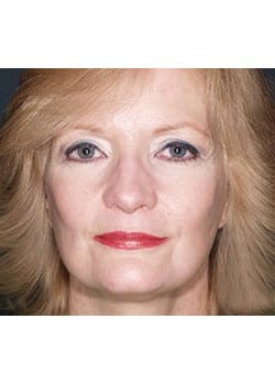 After Image: Ageless Mini Lift - front