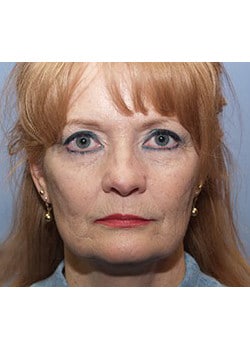 Before Image: Ageless Mini Lift - front