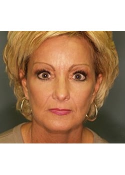 After Image: Ageless Mini Lift - front