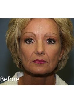 Before Image: Ageless Mini Lift - front