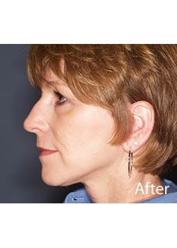 After Image: Ageless Mini Lift - other