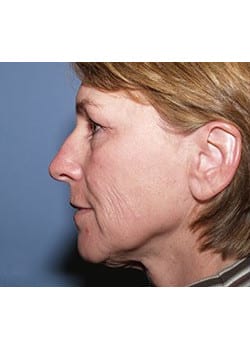 Before Image: Ageless Mini Lift - other