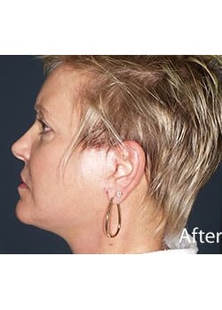 After Image: Ageless Mini Lift - other