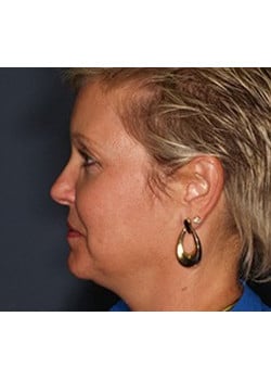 Before Image: Ageless Mini Lift - other
