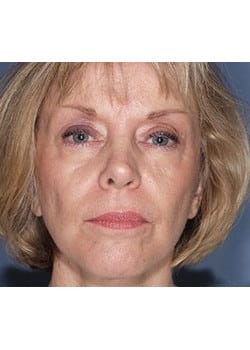 After Image: Ageless Mini Lift - front