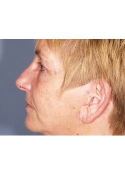 After Image: Ageless Mini Lift - other