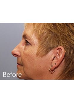 Before Image: Ageless Mini Lift - other