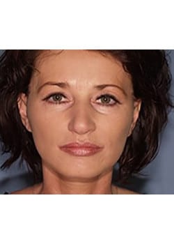 After Image: Ageless Mini Lift - front