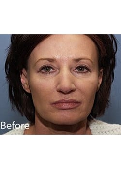 Before Image: Ageless Mini Lift - front