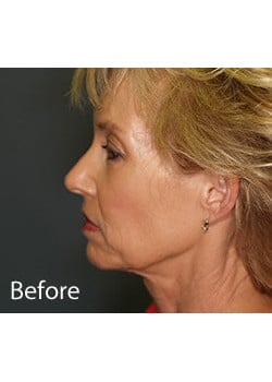 Before Image: Ageless Mini Lift - other
