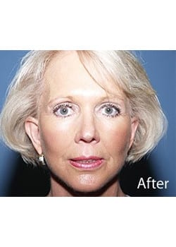 After Image: Ageless Mini Lift - front