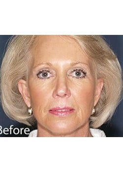 Before Image: Ageless Mini Lift - front