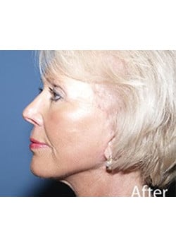After Image: Ageless Mini Lift - other