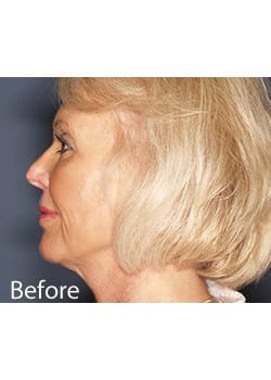 Before Image: Ageless Mini Lift - other