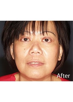 After Image: Ageless Mini Lift - front