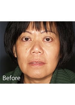 Before Image: Ageless Mini Lift - front