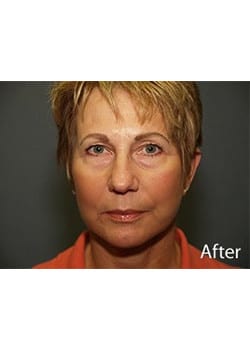 After Image: Ageless Mini Lift - front