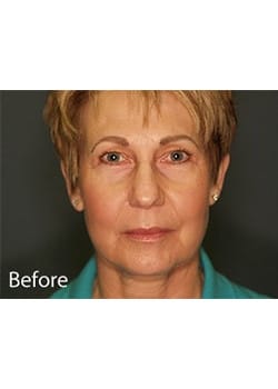 Before Image: Ageless Mini Lift - front