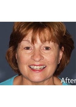 After Image: Ageless Mini Lift - front