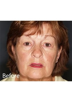 Before Image: Ageless Mini Lift - front
