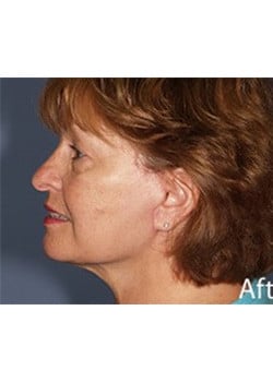 After Image: Ageless Mini Lift - other