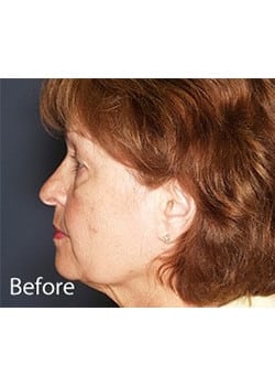 Before Image: Ageless Mini Lift - other