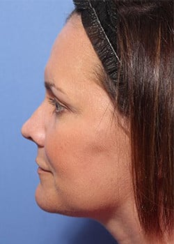 After Image: Ageless Mini Lift - other