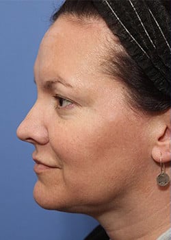 Before Image: Ageless Mini Lift - other