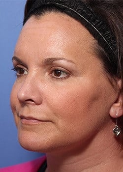 After Image: Ageless Mini Lift - left-front-oblique
