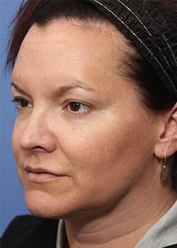 Before Image: Ageless Mini Lift - left-front-oblique