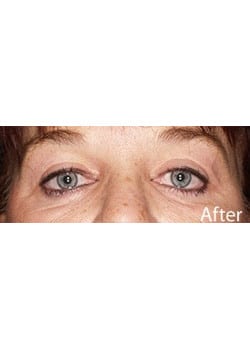 After Image: Eyelid Lift