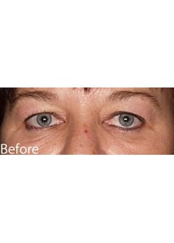 Before Image: Eyelid Lift