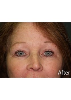 After Image: Eyelid Lift - front