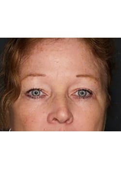 Before Image: Eyelid Lift - front