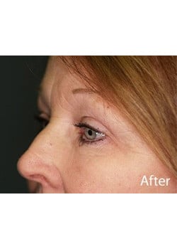 After Image: Eyelid Lift - left-front-oblique