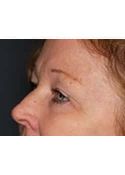 Before Image: Eyelid Lift - left-front-oblique