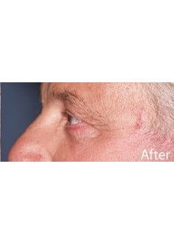 After Image: Eyelid Lift