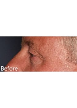 Before Image: Eyelid Lift