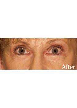 After Image: Eyelid Lift - other