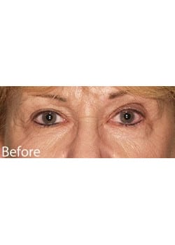 Before Image: Eyelid Lift - other