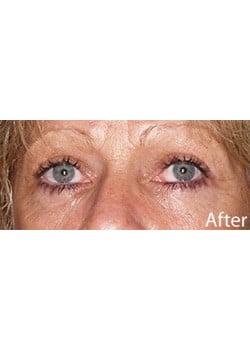 After Image: Eyelid Lift - other