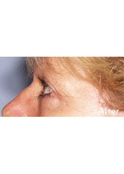 After Image: Eyelid Lift - other