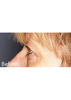 Before Image: Eyelid Lift - other