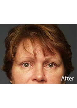 After Image: Eyelid Lift - front
