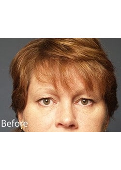 Before Image: Eyelid Lift - front