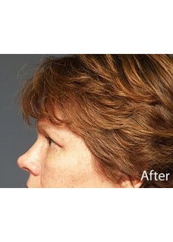 Eyelid Lift