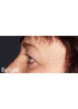 Before Image: Eyelid Lift - other